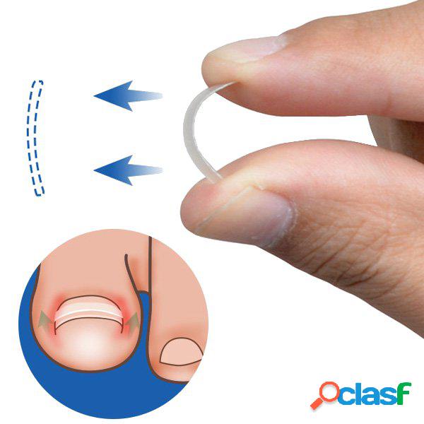 Corrección de la uña del dedo del pie encarnada BS